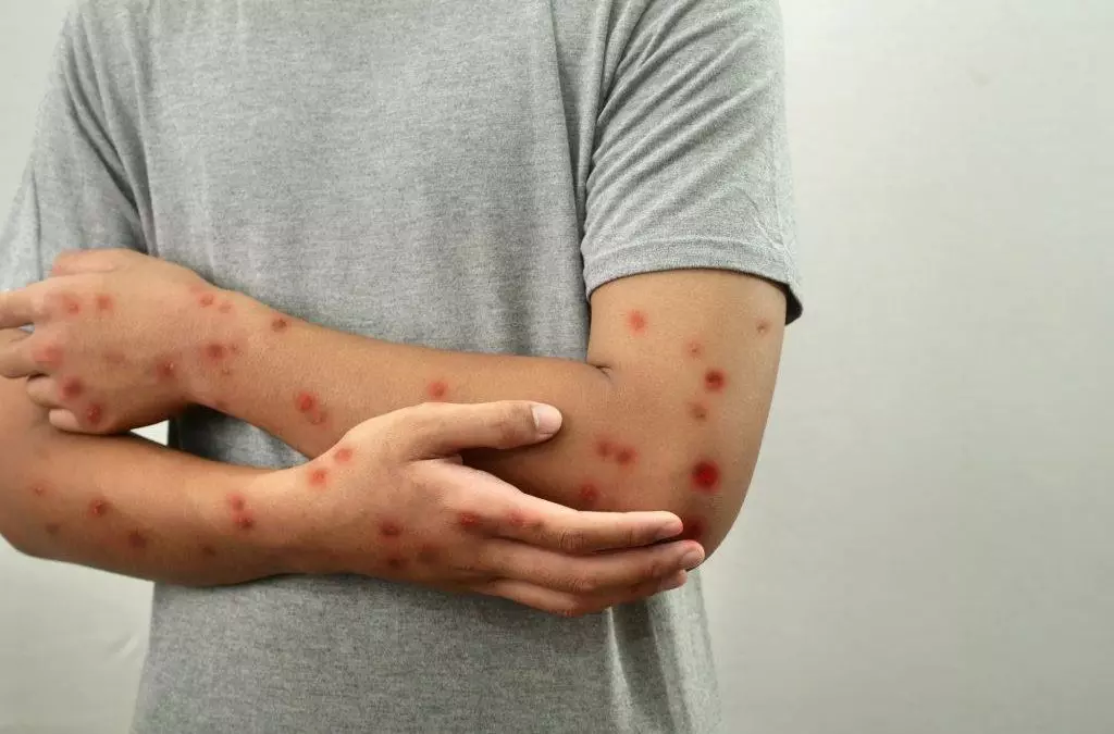 MG confirma o quinto caso de mpox neste ano