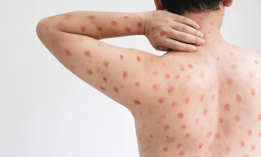 Sobe para 140 número de casos confirmados de Mpox no país, em 2026
