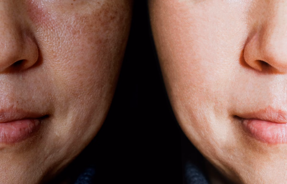 Melasma não é falta de cuidado! Entenda o que é e como lidar com a hiperpigmentação da pele