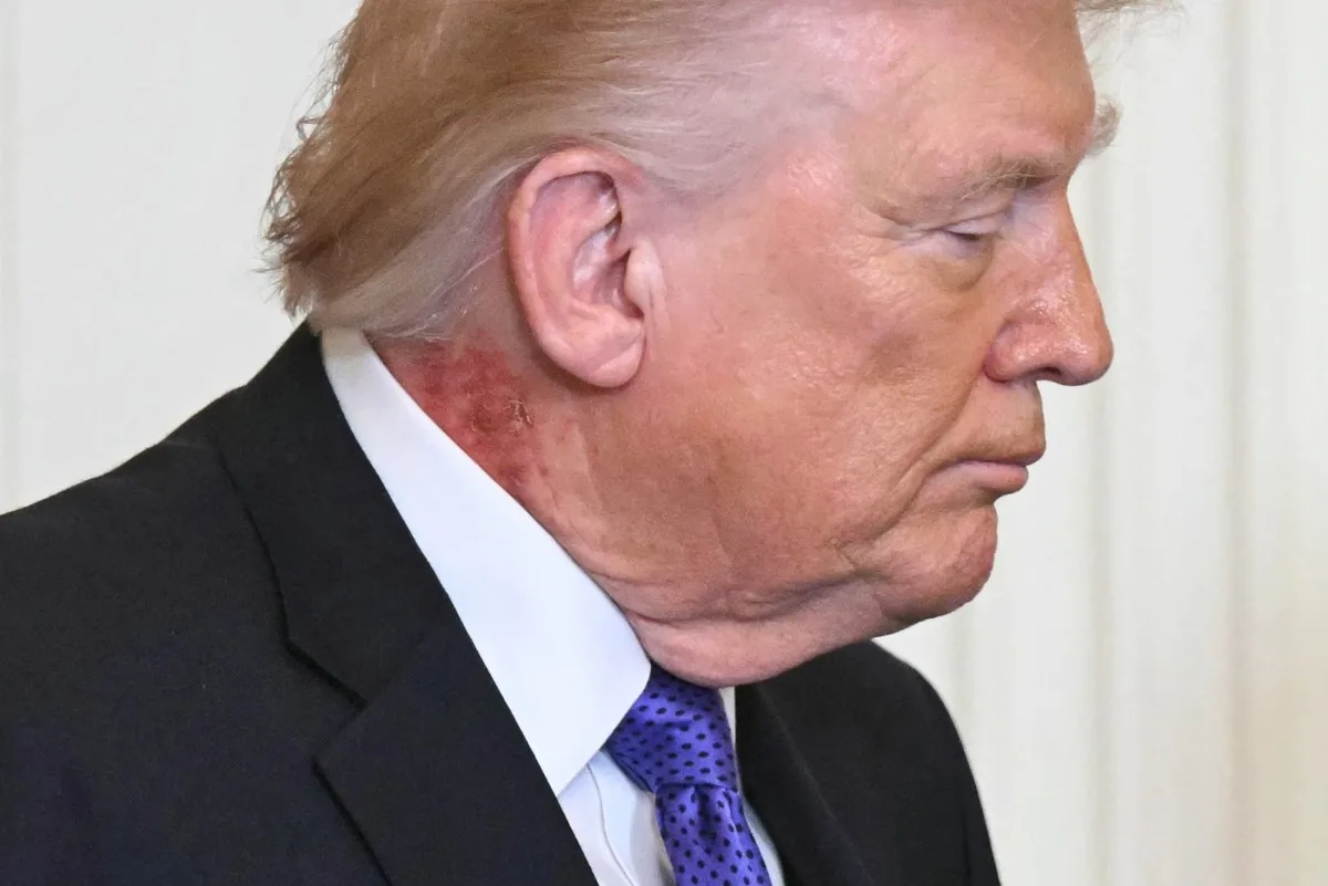 Trump é visto com grande mancha vermelha no pescoço